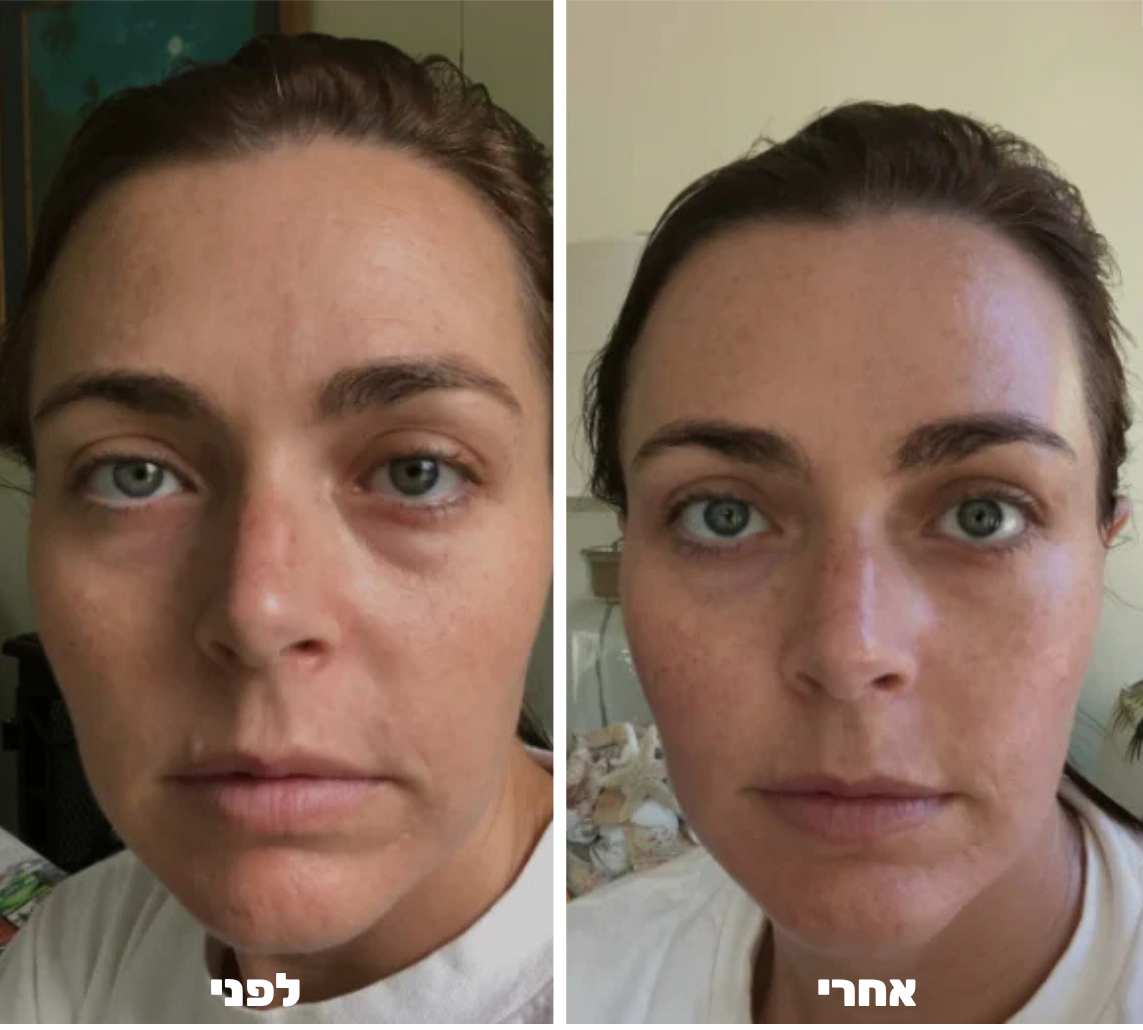 עט מיקרונידלינג לפנים - ™Althé