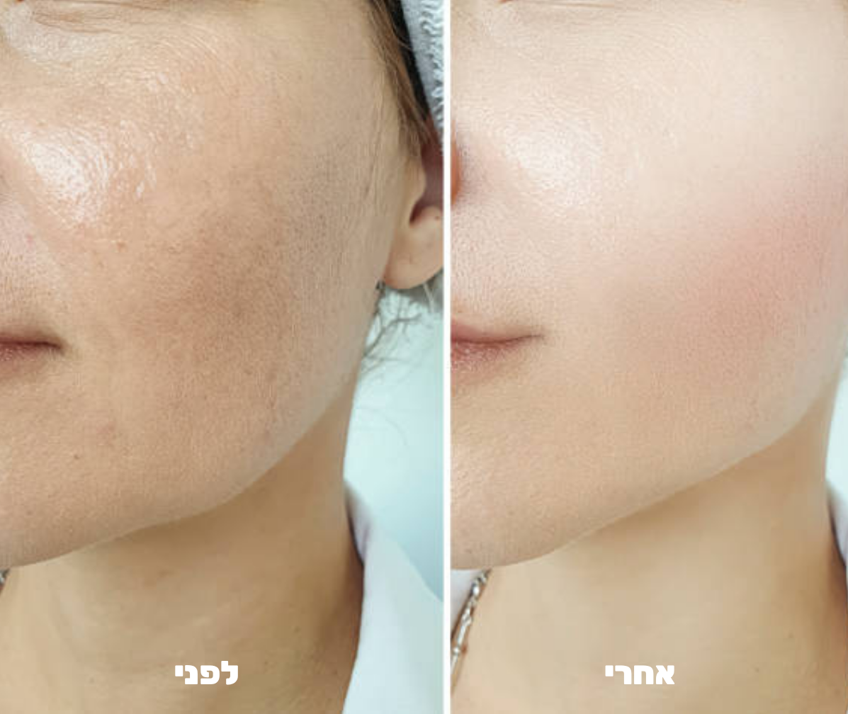 עט מיקרונידלינג לפנים - ™Althé