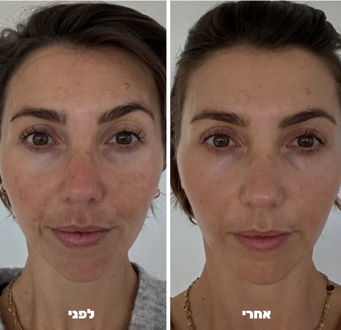 עט מיקרונידלינג לפנים - ™Althé