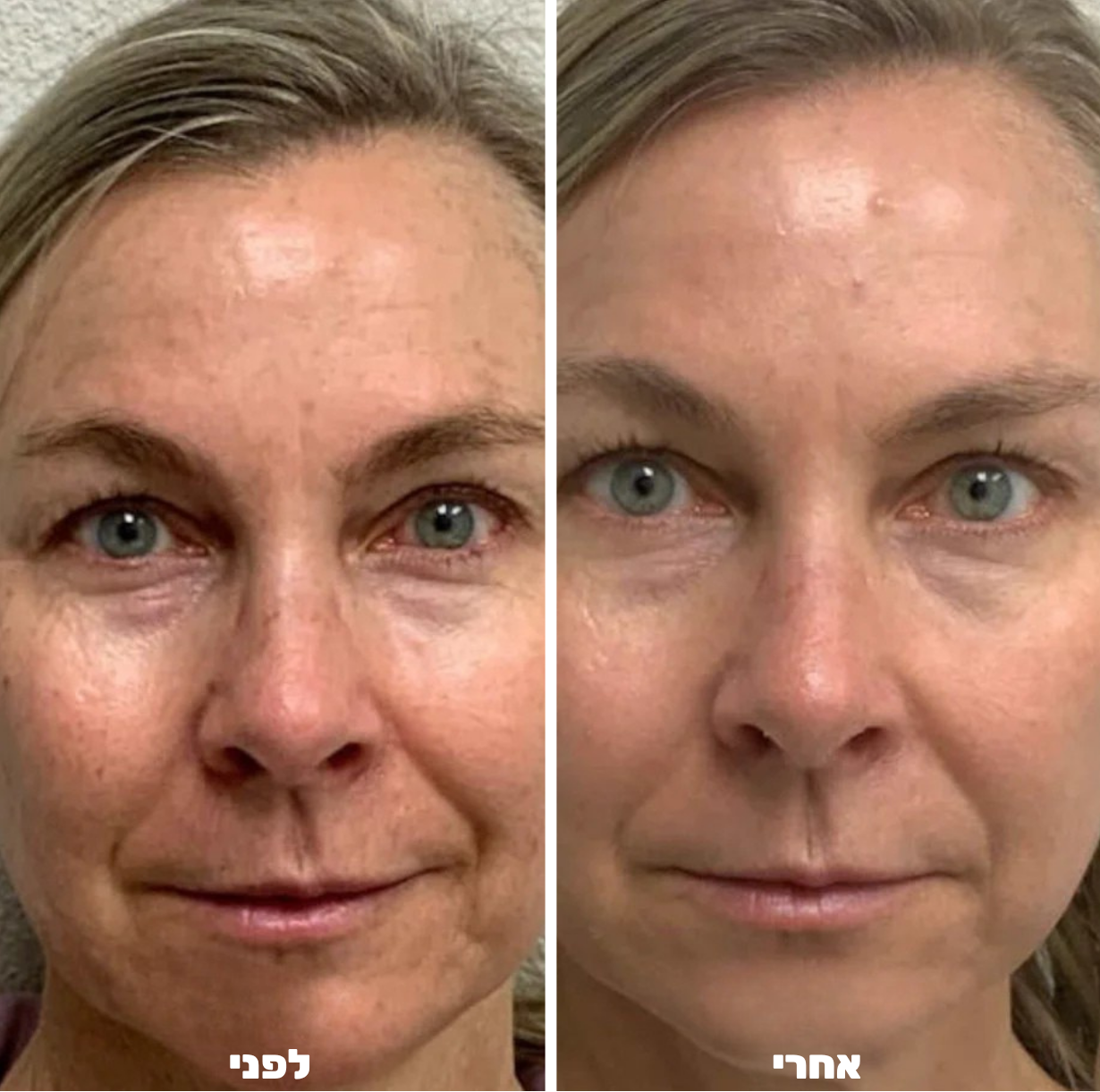 עט מיקרונידלינג לפנים - ™Althé